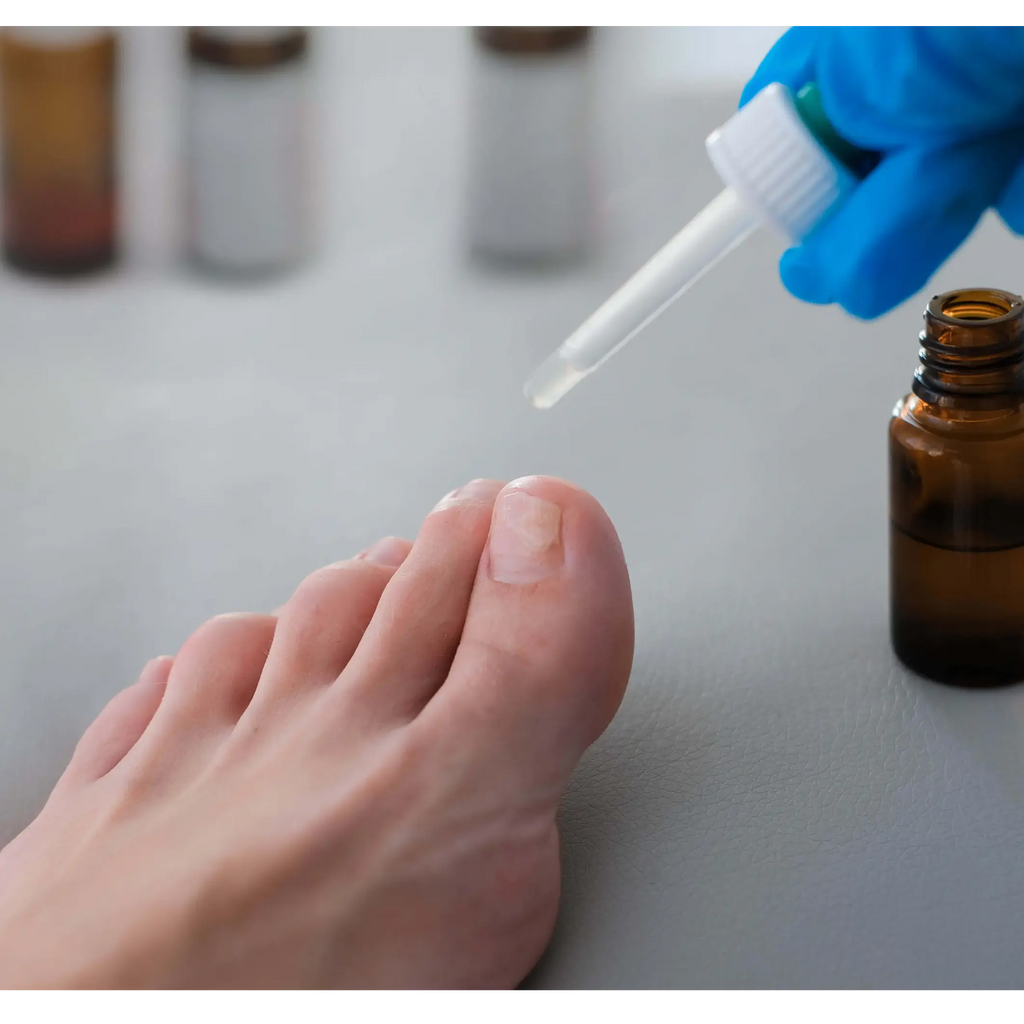 Top Nail Fungus Treatments for Healthier Nails